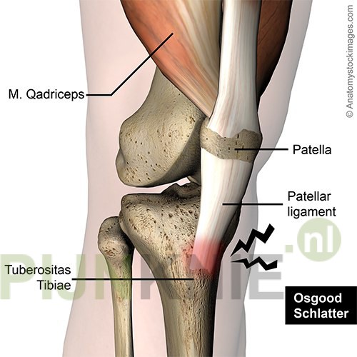 Pijnlocatie bij Osgood-Schlatter
