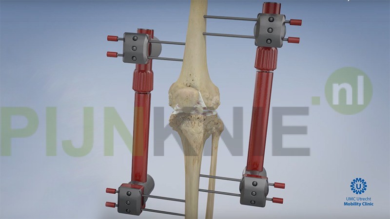 De kniedistractie operatie: een nieuwe behandeling bij een versleten knie