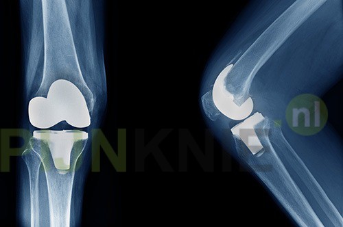 Vijf tips voor een nieuwe knie
