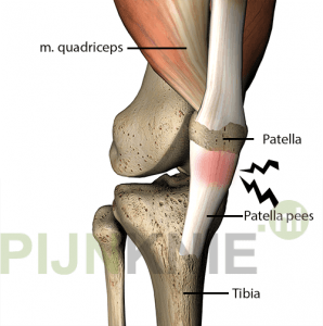 Image 1: patella-tendinopathie