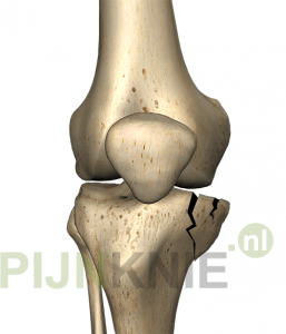 Image 1: tibiaplateufractuur2