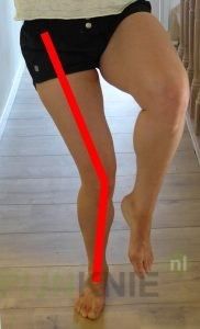 De X-knie of kniehoek. Wat wordt ermee bedoeld?