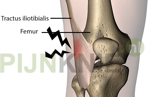 Runners knee, een typische hardloopblessure?