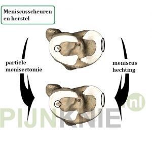 Behandeling van meniscusklachten door de tijd heen