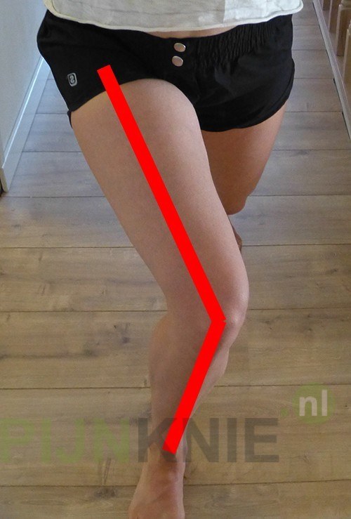 De X knie of kniehoek. Wat wordt ermee bedoeld Pijn Knie